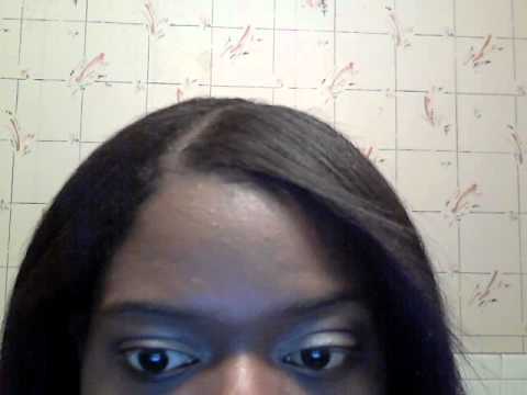 how to correct strabismus in adults how to correct strabismus in adults
