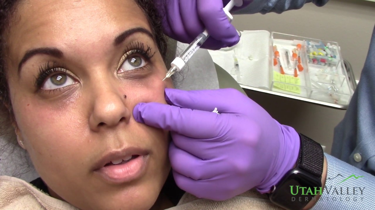 Under Eye Filler Utah Valley Dermatology YouTube