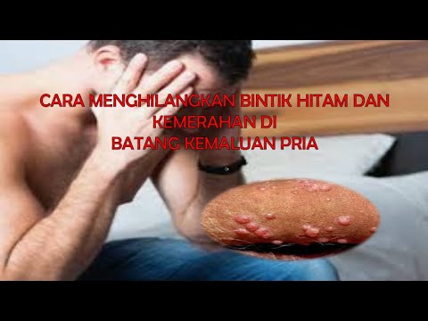 CARA MENGHILANGKAN BINTIK HITAM DAN KEMERAHAN DI BATANG KEMALUAN PRIA
