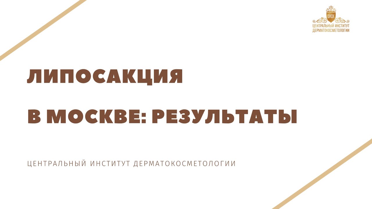 Липосакция до и после в Москве - YouTube