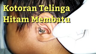 Mengeluarkan Kotoran Telinga Anak