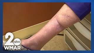 A new treatment for melanoma