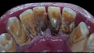 29 yo. Male's Teeth | Calculus | Tartar | Scaling | Karang Gigi | Dentist | Dokter Gigi Tri Putra
