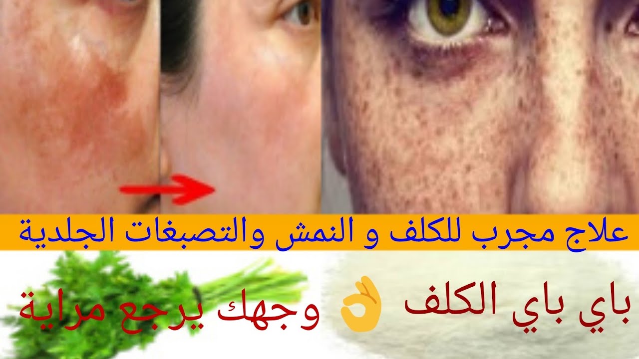 بدون ما اقسم انجح وصفة لعلاج الكلف و النمش والتصبغات الجلدية في اسبوع على ضمانتي✔️