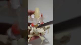 Exploring Discectomy Dynamic Disc Model #lumbar Spinal Bifida Dynamic Disc Model Lumbar