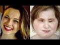 El increíble trasplante de cara a una adolescente que intentó suicidarse