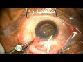 Learn step by step small incision cataract surgery scleral tunnel