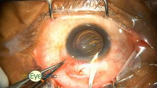 Learn Step by step small incision cataract surgery- scleral tunnel