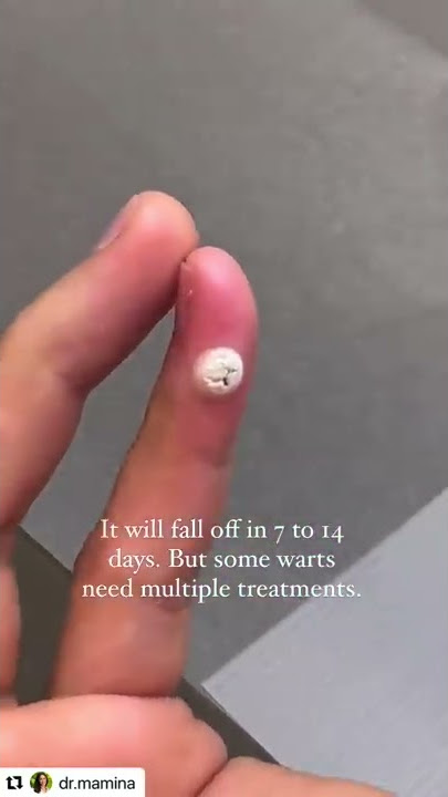 Freezing a Wart