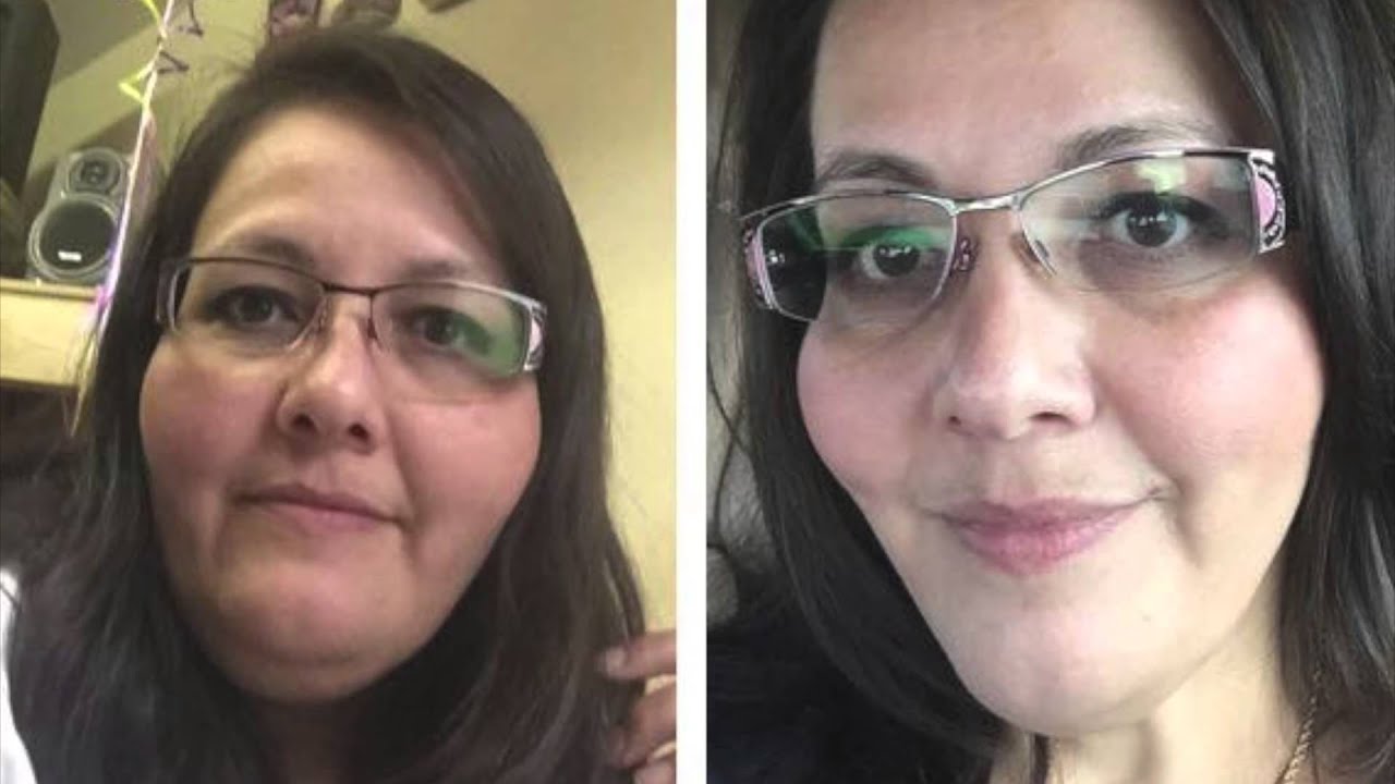 face slimming surgery before and after before and after