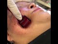 イセアクリニックのダーマローラ― 施術動画