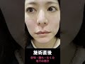 クレーターを治すためにダーマペンをした結果 #クレーター #クレーター肌 #肌質改善 #クレーター解消 #ダーマペン #ミラノリピール 全編→https://youtu.be/6EMIEDbBcjA