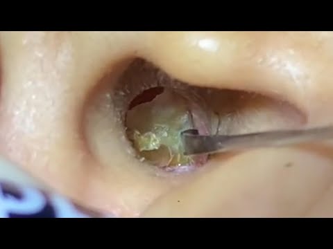 ASMR Ear Cleaning – I Thought It Was Done… But Then This Happened