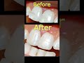 chipped tooth repair