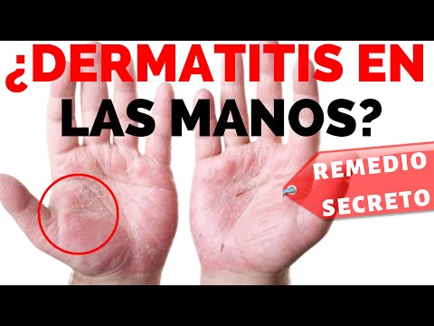 Vídeo: Piel Agrietada En Dedos, Manos, Pies Y Labios: Causas Y Tratamiento