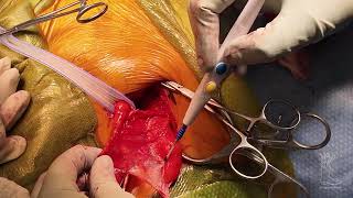 Season 4 Bonus: Inguinal Hernia Explained & Repaired | Surgery in Boots