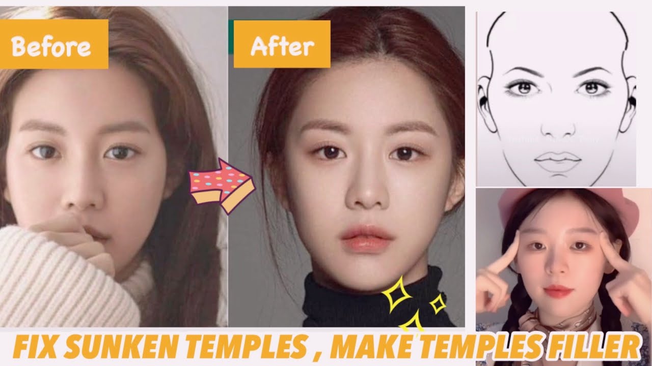 🔥🌈 How To Fix Sunken Temples, Hollow Temples Natural!✨  Make Temples Filler With Exercises!
