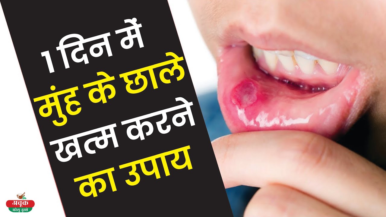 1 दिन में मुंह के छाले खत्म करने का घरेलु उपाय Mouth Ulcer Treatment Muh Ke Chale Ka Ilaj