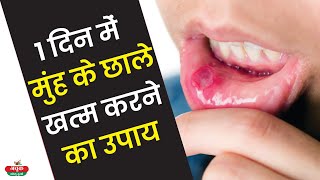 1 दिन में मुंह के छाले खत्म करने का घरेलु उपाय | Mouth Ulcer Treatment | Muh Ke Chale Ka Ilaj