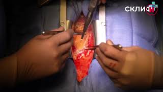Операция по шунтированию артерий пациенту с атеросклерозом