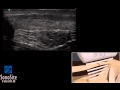 How To: Pathology Ankle Achilles Tendon Tear 3D Video