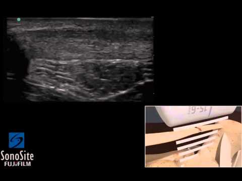 Image of How To: Pathology Ankle Achilles Tendon Tear 3D Video
