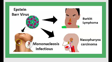 Comment detecter un lymphome de Burkitt ?