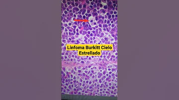 ¿Cuáles son los signos del linfoma de Burkitt?