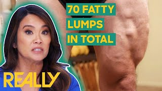 Dr. Lee Removes 27 Lipomas From A Patient's Body | Dr. Pimple Popper