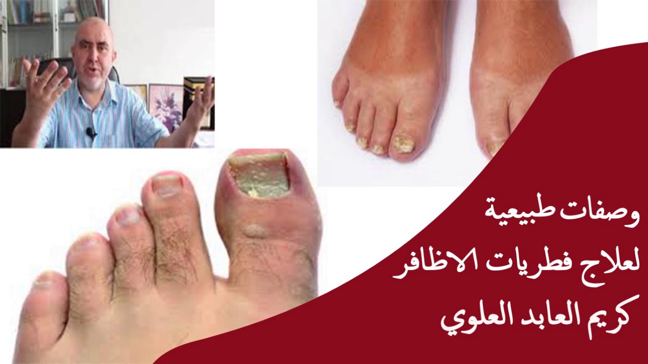 وصفات طبيعية لعلاج فطريات الاظافر / الدكتور كريم العابد العلوي
