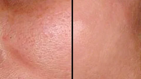 HOW TO: MAKE PORES DISAPPEAR IN SECONDS - GOOD FOR ACNE PRONE SKIN! - DayDayNews