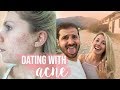 DATING WITH ACNE: WHAT HE REALLY THOUGHT OF MY SKIN