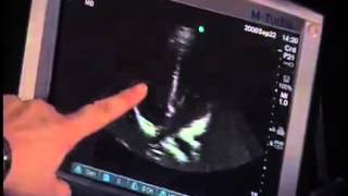 How to:  Focused Echo - Apical View With Ultrasound
