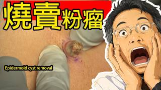 像燒賣的背部粉瘤