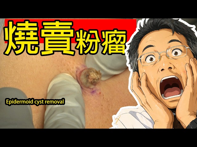 像燒賣的背部粉瘤