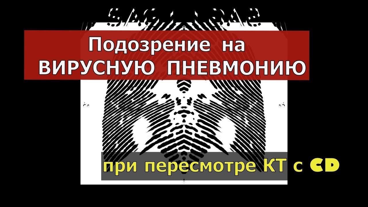 Левосторонняя нижнедолевая ПНЕВМОНИЯ (ВИРУСНАЯ?) на РАСШИФРОВКЕ КТ грудной клетки