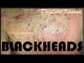 Blackheads Removal Full Video by Dr Lalit Kasana