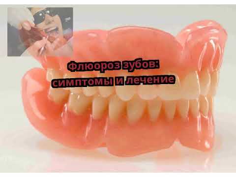 Флюороз зубов: симптомы и лечение
