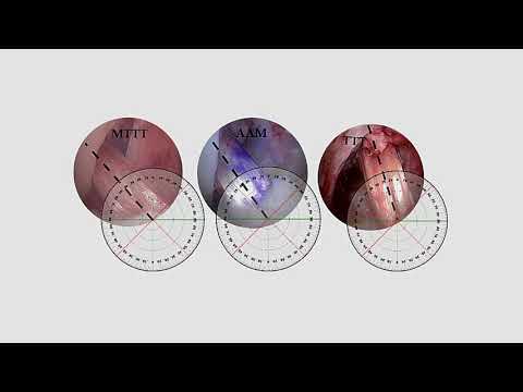 Modified transtibial VS anteromedial portal techniques – Video abstract [ID 157729]