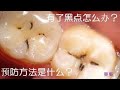 牙齒上的小黑點是怎麼回事?有了黑點怎麼辦?預防方法是什麼
