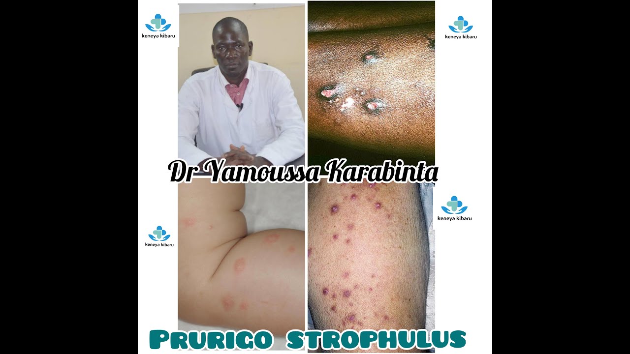 Le prurigo strophulus - YouTube