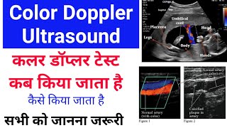 Colour Doppler ultrasound कब किया जाता है - और कैसे होता है screenshot 3