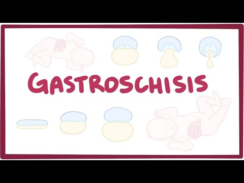 Gastroschisis - an Osmosis Preview