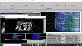5 Manejo De Curvas De Isodosis Y Obtención Del Histograma De Dosis-Volumen