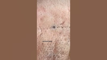 Firefighter Blackheads 👨‍🚒 | Dr. Pimple Popper #drpimplepopper #shorts #pimple #blackheads