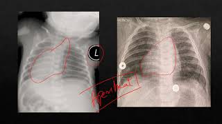 Radiology findings on pre op Xray in Esophageal atresia with Tracheo-esophageal fistula