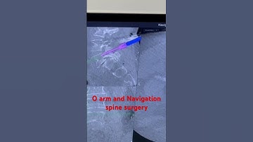 O arm and Navigation guided advanced Spine Surgery best outcomes safety accuracy precision recovery
