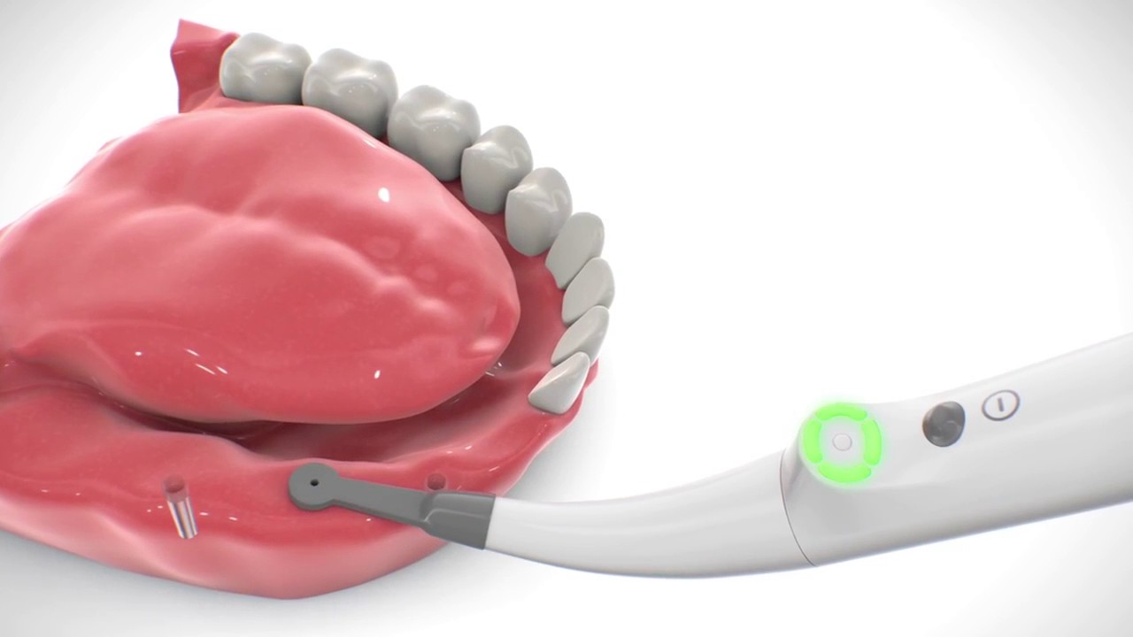 Локатор в имплантологии локатор. Необиотек имплантаты. Implant locator forum. Имплант локатор. Купить локаторы для имплантов.