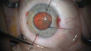 Iris Hooks in cataract surgery