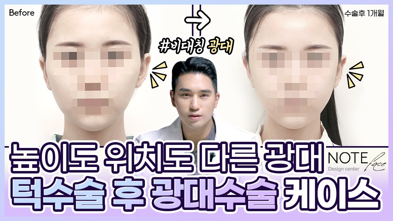 [유.케.리] 📍 CT로 보는 케이스 리뷰 l 광대 비대칭 l  광대 수술 l